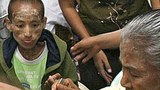 AIDS_patient_PPT_305px.jpg