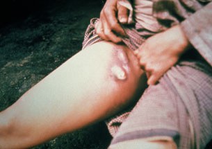 Plague_-buboes_305px.jpg Plague_-buboes_305px.jpg