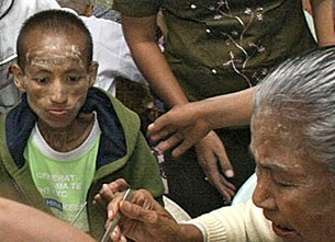 aids_patient_nld_305_z.jpg aids_patient_nld_305_z.jpg