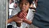 bomb_wounded_305px.jpg