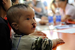 cleft_kid_305px.jpg cleft_kid_305px.jpg