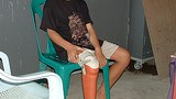 landmine_victim_305px