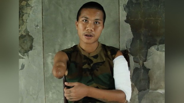 လက်တစ်ဖက် ဆုံးရှုံးရပေမယ့် တော်လှန်နေဦးမယ်ဆိုတဲ့ ကိုမိုးသောက် လက်တစ်ဖက် ဆုံးရှုံးရပေမယ့် တော်လှန်နေဦးမယ်ဆိုတဲ့ ကိုမိုးသောက်