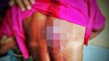 chin-woman-injury-622