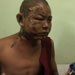 latpadaung-injured-mdy-75 latpadaung-injured-mdy-75