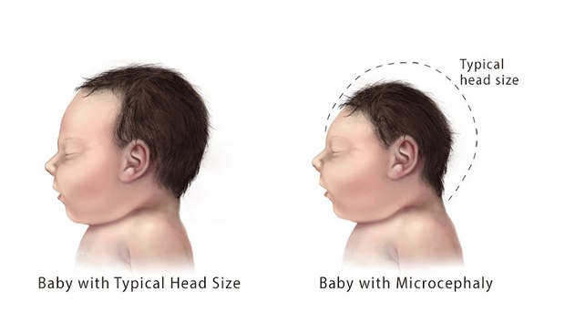 zika-baby-620.jpg zika-baby-620.jpg