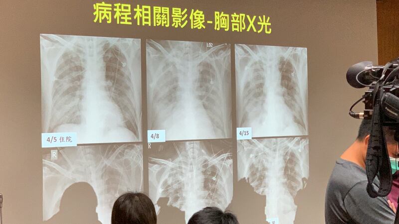 A先生肺部X光医治过程变化。(记者夏小华翻摄)