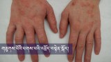གཟུགས་པོའི་པགས་པའི་འཕྲོད་བསྟེན་སྐོར།