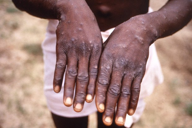 Monkeypox ཟེར་བའི་འབྲུམ་ཐོར་གྱི་ནད།