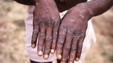 Monkeypox ཟེར་བའི་འབྲུམ་ཐོར་གྱི་ནད།